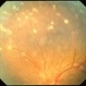 Multifocal Choroiditis & Panuveitis Syndrome